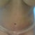 After tummy tuck 2d day post op