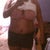 Front view Before tummy tuck