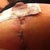 1st bandage has come off/1st look at stitches.