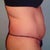 PS-Pre-Op pic Note lack of attachment if muscles right after ribs