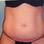 PS-Pre-Op pic
Frowning belly button one of the top signs you need a tt