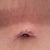 BB raised scar