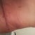 scar tx 2 weeks