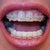 My old dentist shaved my front teeth uneven to move them.  I wish he hadn't done this.  First day top and bottom teeth still slightly crowded.