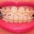 First day I think the teeth need to be pull to the left and to the right and down.