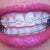 Day 1 of Ceramic Braces.