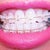 15 days after Ceramic Braces.