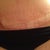 Post Op Day 33 - closer view of right groin area incision opening