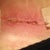 Post Op Day 33 - even closer view of right groin area ncision opening!