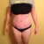 Post Op Day 33 - front view