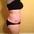 Post Op Day 33 - right side