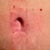 Post Op day 33 - Belly Button!