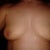 3 wks post op (Marks are from sports bra)