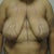 Right before the surgery -- the mark-up