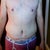 3.5 Weeks Post Op - Swelling starting to go down.