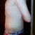 3.5 Weeks Post Op Side View - Swelling starting to subside.