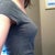 04-18-12.  After surgery, 7 weeks post-op.  You can see how my breasts have taken shape. They have a nice, even slope.