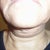 my neck fell when the scare tissue was not done right