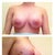 Day 13 Post Op