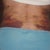 Post-op day 3, very bruised but not painful.  No more muffin top!!