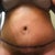 one week post op.