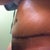 one week post op