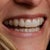 Teeth at tray set #31.  I like to smile now!  You can see a couple of attachments if you look closely.
