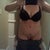 5 days post op front view. I am very swollen and bruised.