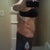 5 days post op right side