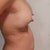 Side shot right breast at 2 days post-op.