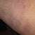 Post Opp day 4