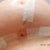 Ok heres a shot of the T junction at the bottom of my right breast (sorry its blurry, my camera sucks) it looks like a tiny triangle shaped open spot that continues to ooze a bit & had bloody spots in my bra from it. I put polysporin on it yesterday, 2 times & took the tape off it to let it air a bit & it seemed to help a bit but I just read polysporin is not the best idea. any thoughts?? also does anyone else have those little dimply  things along your incisions? stitches I assume?