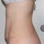 Side View - 3 weeks post op