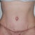 Front view - 3 weeks post op