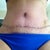 Bathing suit pulled down for a better look at incision area