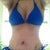Bathing suit in normal position...side scars very visible