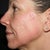 Day #6 Left side - the side with more pre-fraxel skin issues.