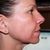 Day #6 Right side - finaly starting to look more normal - though still red/scaly below my mouth.