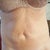 6 months post-op