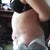 13 days post op