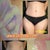 Before surgery and 14 Weeks after from Dr D's Office Composite that he gives to his patients :)