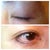 6 months post -op/ close up scar views on upper & bottom lids. Very fine lines. Undetectable with naked eye per family