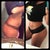 AND before and after side view one month post op.. Crazy huh..