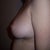 left side 6 days post op