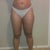 Hip & Thigh Before