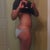 Hip & Thigh at 3 months after (side view)