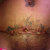 15 days post op possibly looking better