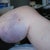 Post Opp day 1 Lipo on thighs