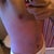 Post Op - Day 7 - One week down and swelling is improving.
