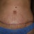 2 weeks post op - tummy tuck close up